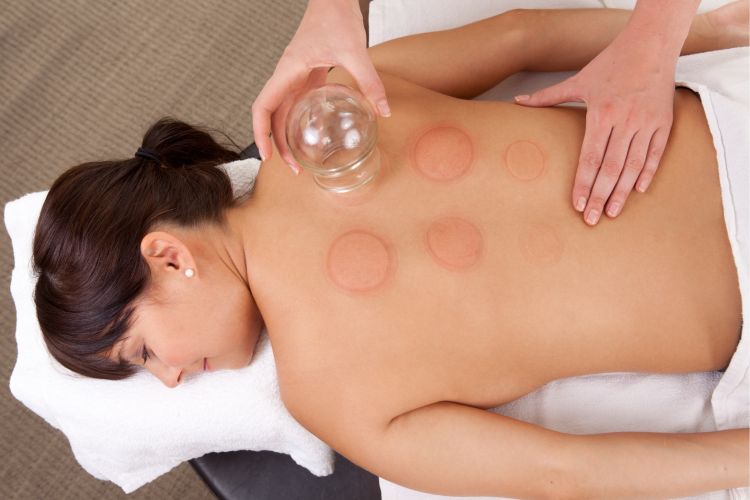A person is lying face down on a massage table receiving cupping therapy, with several round marks visible on their back.