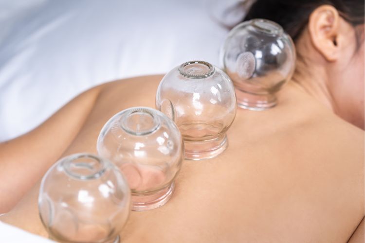 A person lying face down receives cupping therapy with four glass cups placed along their upper back.